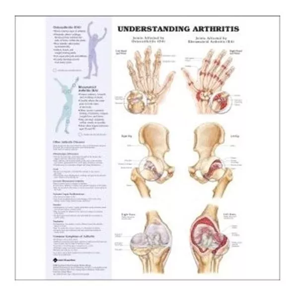 Wolters Kluwer HealthChart Anatomical Arthritis/Joint 20x26" Ea