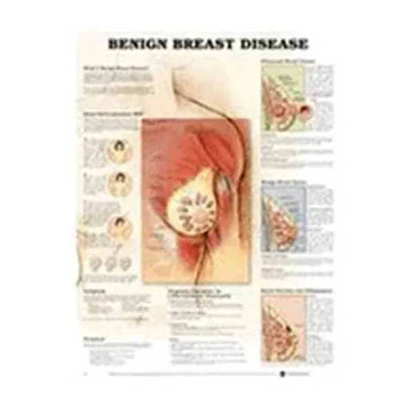 Wolters Kluwer HealthChart Anatomical Benign Breast Disease 20x26" Ea