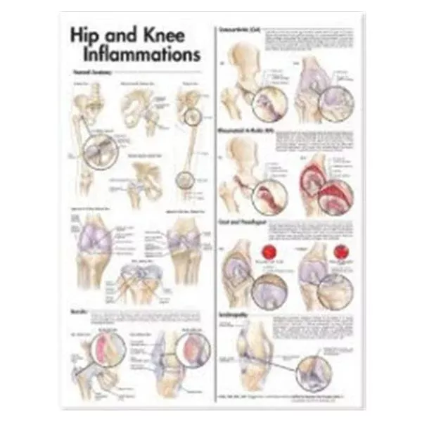 Wolters Kluwer HealthChart Anatomical Hip and Knee Inflammations 20x26" Ea