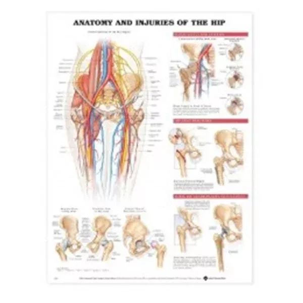 Wolters Kluwer HealthChart Anatomical Injuries of the Hip 20x26" Ea