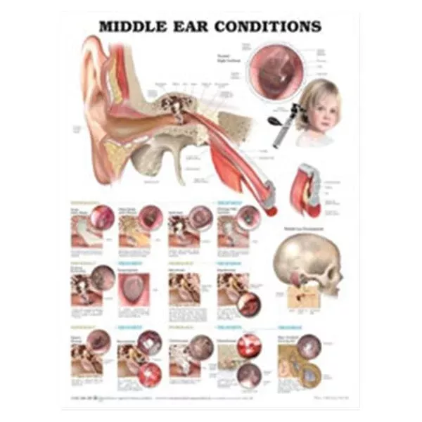 Wolters Kluwer HealthChart Anatomical Middle Ear Conditions 20x26" EA