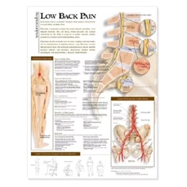 Wolters Kluwer HealthChart Anatomical Understanding Low Back Pain 20x26" Ea (9780781782425)