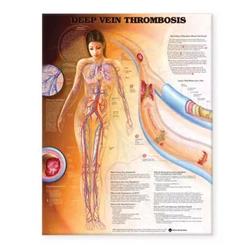 Wolters Kluwer HealthChart Clinical Deep Vein Thrombosis 19" x 26" Ea