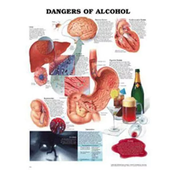 Wolters Kluwer HealthChart Educational Dangers of Alcohol 20x26" Ea