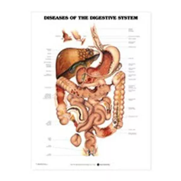 Wolters Kluwer HealthChart Educational Diseases of The Digestive System Eng 20x26" Ea