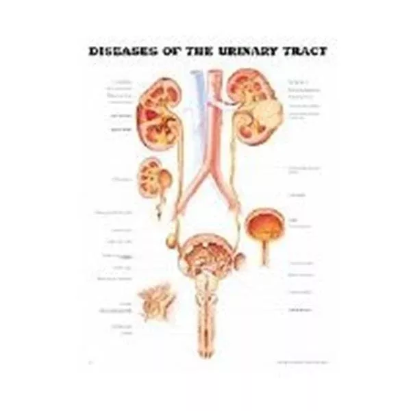 Wolters Kluwer HealthChart Educational Diseases of Urine Tract 20x26" Ea