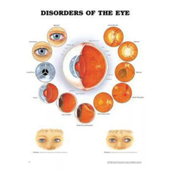 Wolters Kluwer HealthChart Educational Disorder of the Eye 20x26" Ea