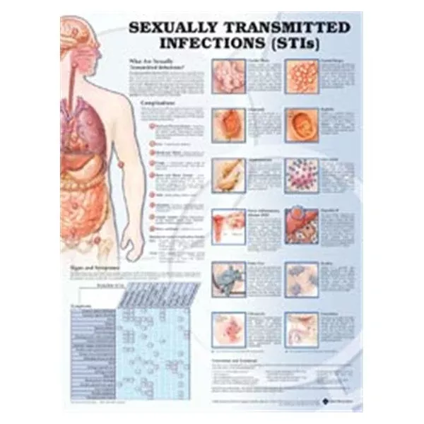 Wolters Kluwer HealthChart Educational Sexually Transmitted Infections 20x26" Ea
